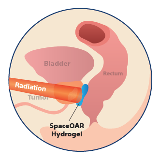 SpaceOAR Hydrogel with Radiation Therapy